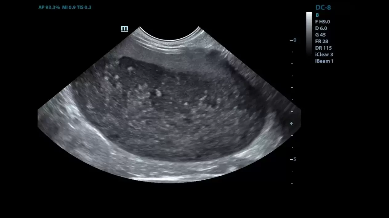 Cistite em minhas imagens de ultrassom antes do uso de Cystolax