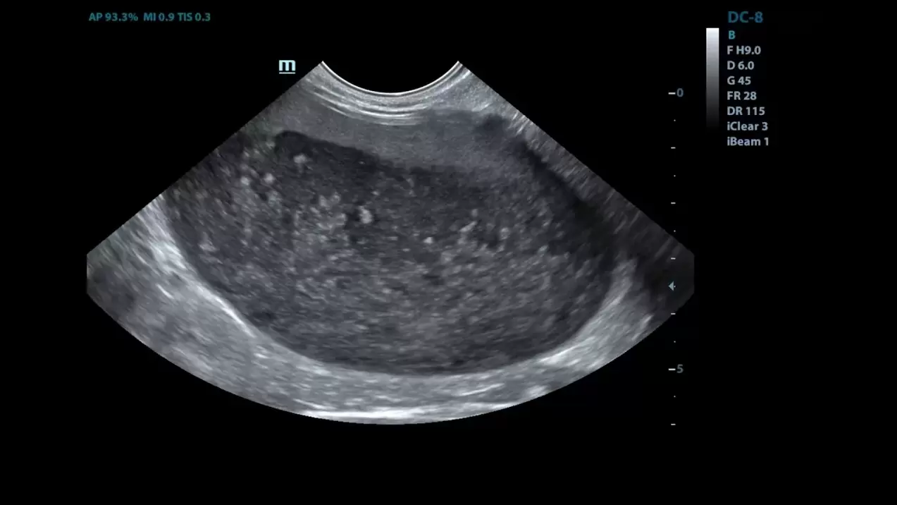 Cistite em minhas imagens de ultrassom antes do uso de cistolax