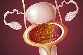 Cistite bacteriana em uma mulher